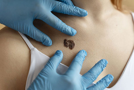 El extracto de cannabis ha demostrado ser efectivo en la lucha contra el c&aacute;ncer de piel (melanoma)